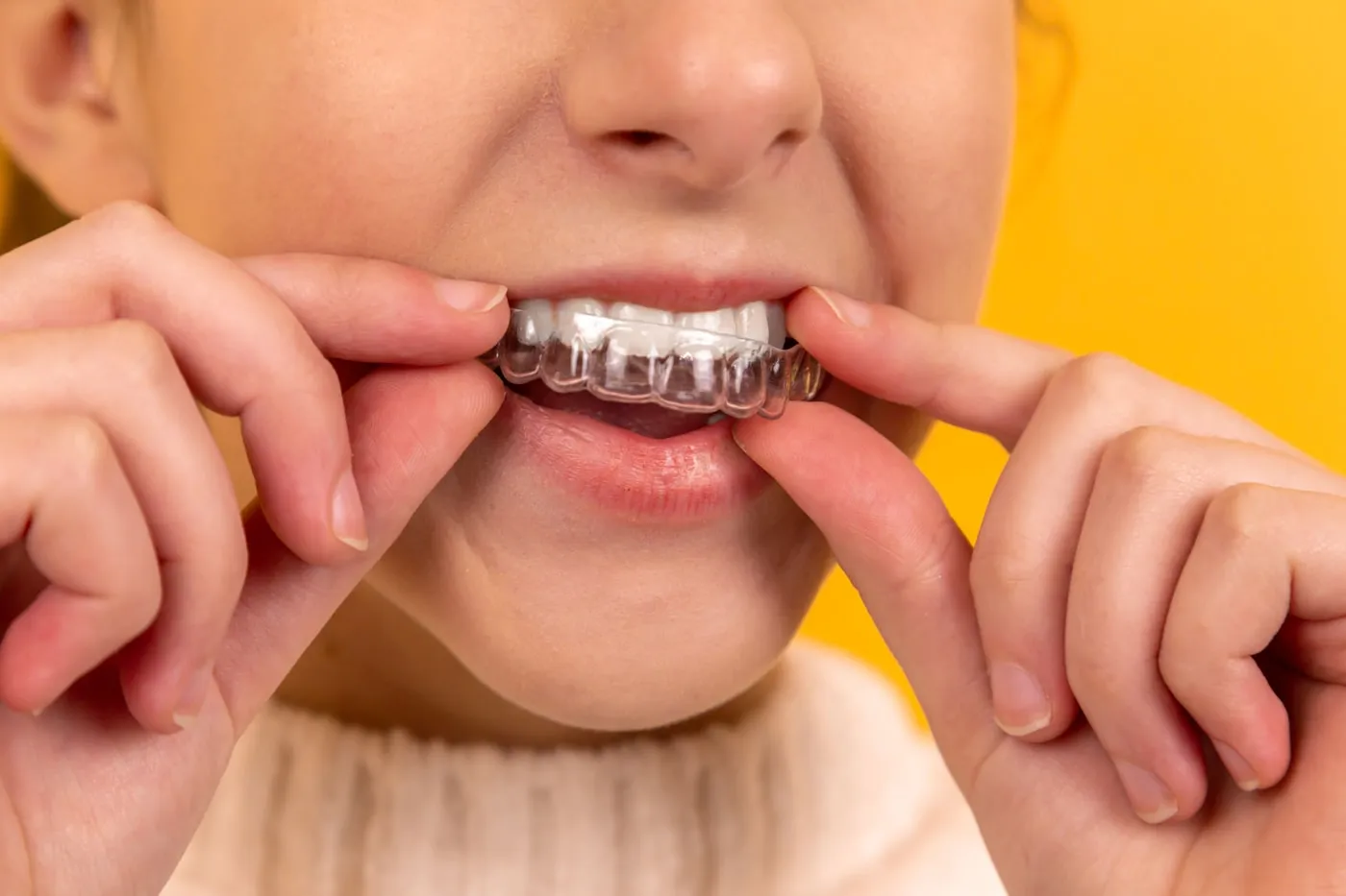 Patient placing a clear aligner tray at Dream Smile Dental Clinic Indore