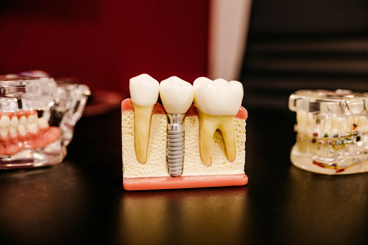 Dental Implants in Indore