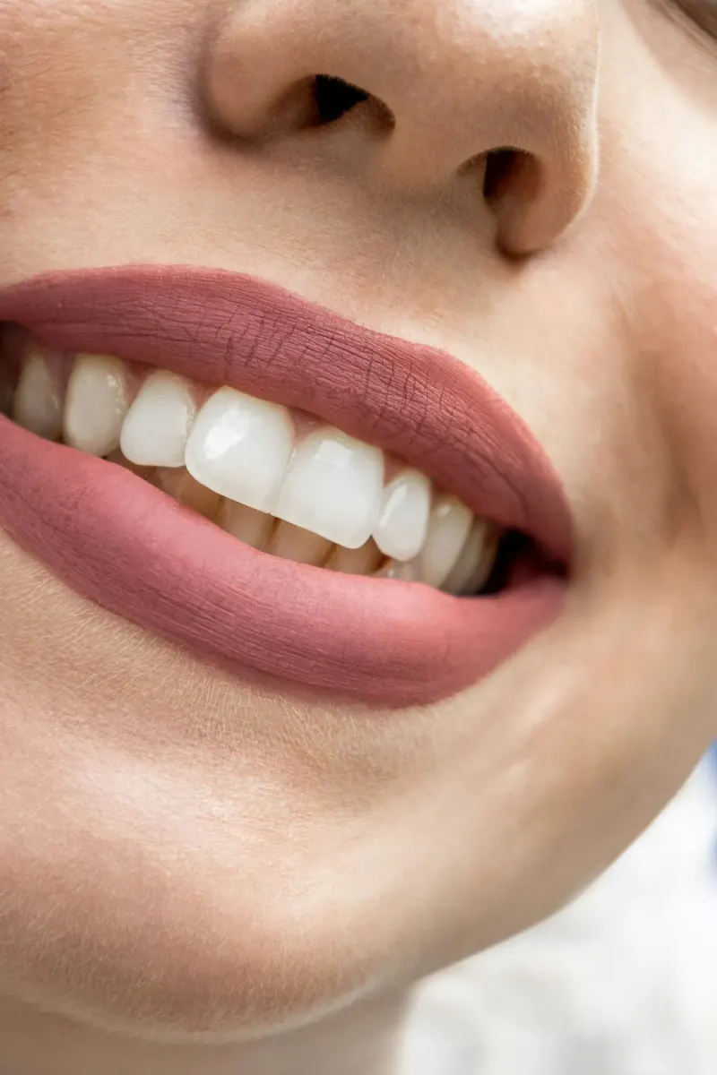 Teeth Polishing in Indore at Dream Smile Dental Clinic, Indore